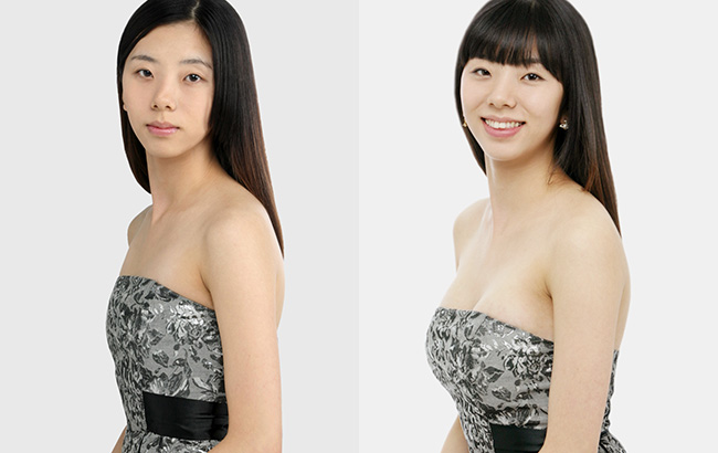 个性化隆胸丰盈动感-自信