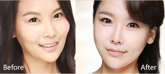 爱情保鲜的秘密注射除皱