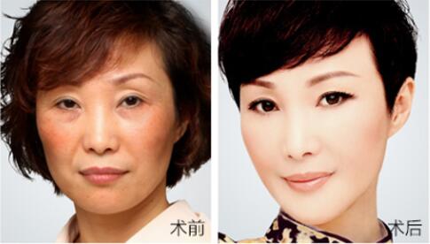 玻尿酸除皱 天然又安全