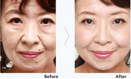 玻尿酸注射除皱的怎么样