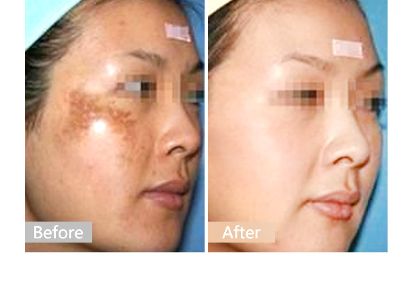 上海美莱祛斑好吗