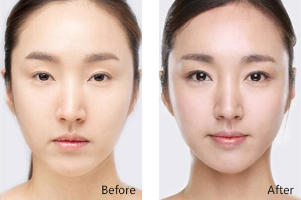 开眼角手术恢复影响因素有哪些