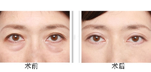 激光去眼袋如何