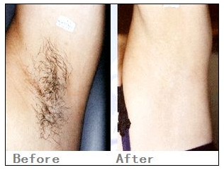 彩光脱毛会疼吗