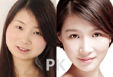 玻尿酸丰下巴的保持时间是多久