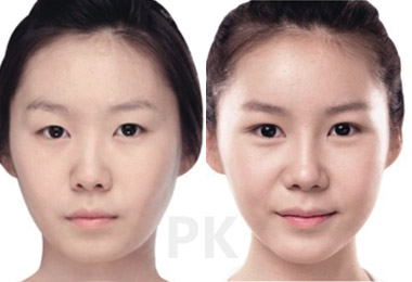 玻尿酸丰下巴的价格是多少