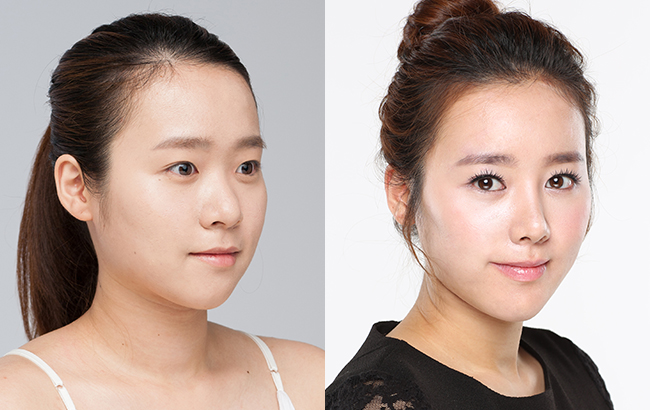 鼻翼整形 让面部更加好