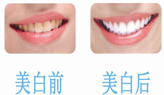 冷光美白牙齿 让自信笑容时刻伴随