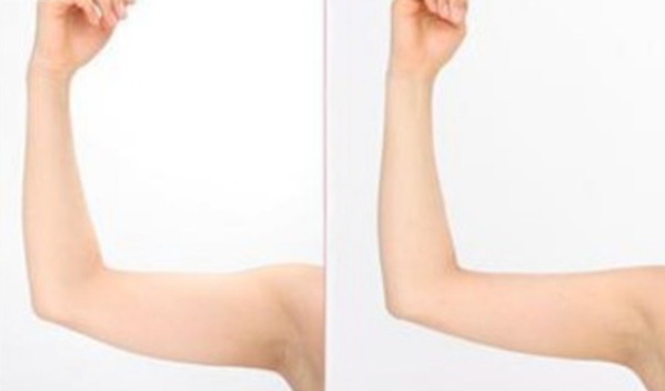 手臂吸脂手术会反弹吗?