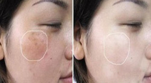 如何判断晒斑及去晒斑的妙法