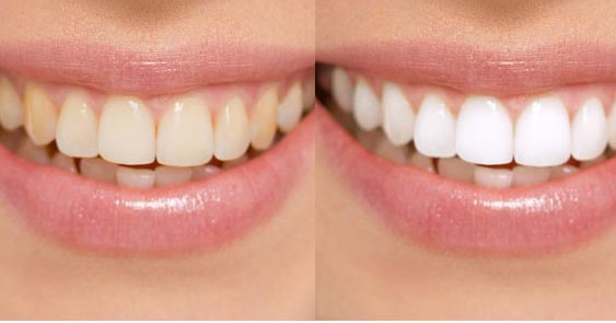 美白牙齿有哪些好处？