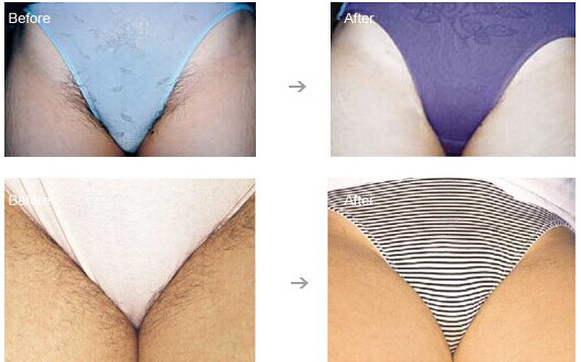 夏日比基尼脱毛，做人人羡慕的“美人鱼”