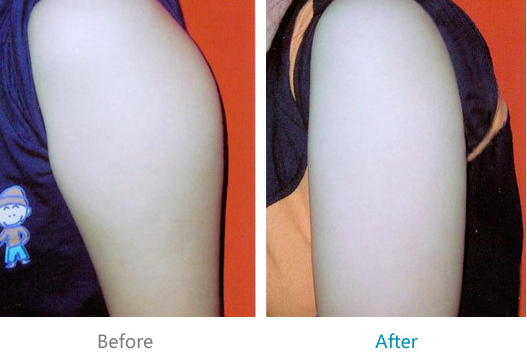 手臂吸脂手术秀出你的风采