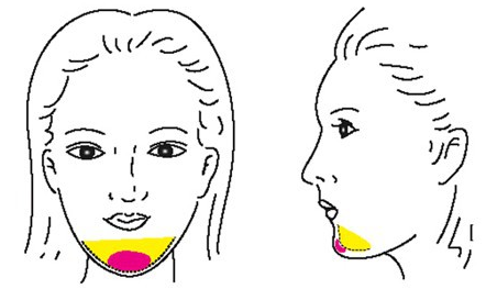 自体脂肪丰下巴优势何在