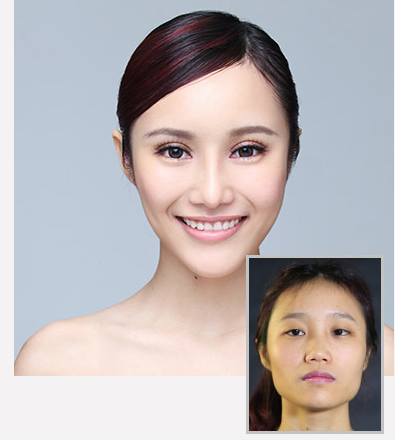 自体脂肪丰下巴优势何在