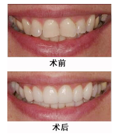 想要矫正牙齿吗，教你鉴别烤瓷牙好坏