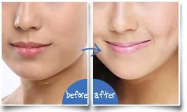 酒窝整形的自然吗？