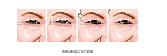 去鱼尾纹，<a href='/' target='_blank'><u>上海美莱</u></a>为你掩盖岁月痕迹！