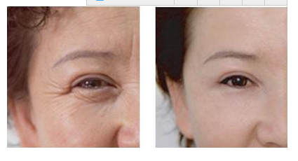 去鱼尾纹，美莱为你掩盖岁月痕迹！