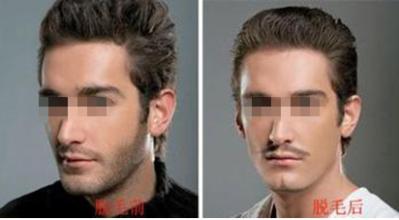 如何祛除男人的络腮胡子