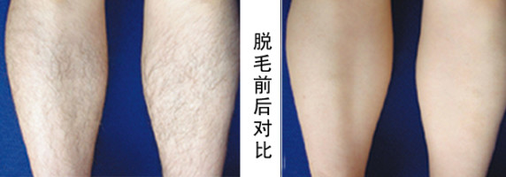 激光腿部脱毛与传统腿部脱毛的比较