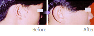 常见的耳部整形手术有哪些