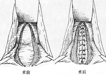 阴道紧缩术后会影响生育吗?