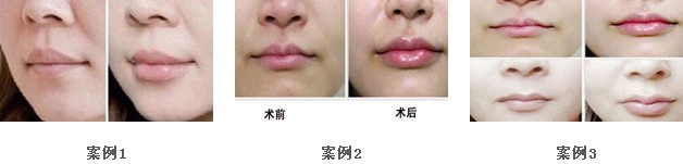 唇部整形手术的护理怎么做