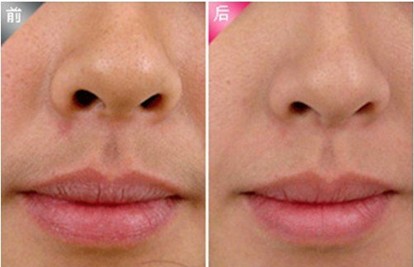通过冰点进行唇部脱毛会不会反复呢  　　