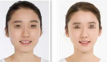 3种下巴整形法使脸部更和谐