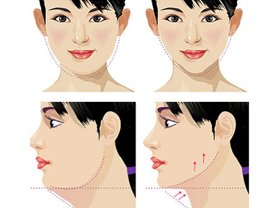 什么是下巴整形