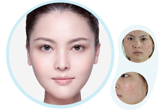 美莱祛痘