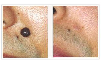 黑痣上的毛能拔吗