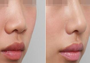 专业隆鼻就到上海美莱