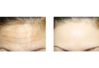 长抬头纹怎么办