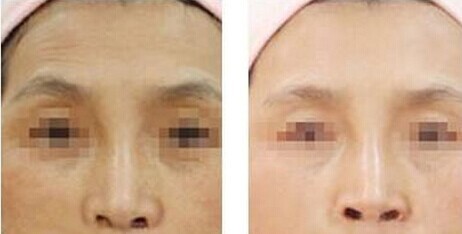 抬头皱如何消除  　　