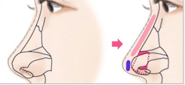 假体隆鼻疼吗,需要多长时间