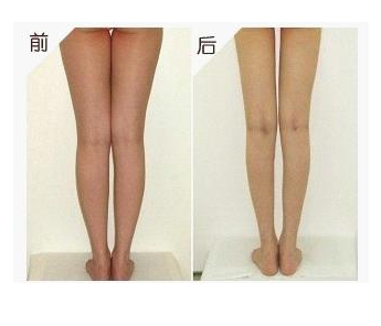 肌肉小腿退缩瘦腿术  　　