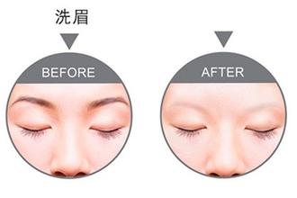 激光洗眉后天图片