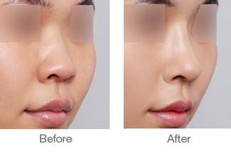 隆鼻有危险吗咨询上海美莱  　　