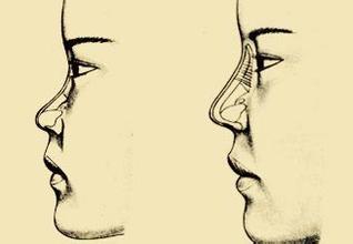 隆鼻有危险吗咨询上海美莱  　　