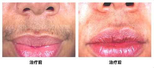 去唇毛的小妙招，冰点激光更