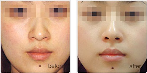 微针美容可能变毁容