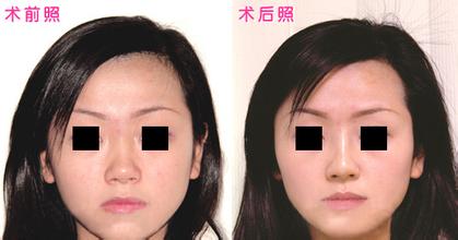 膨体隆鼻术就到美莱