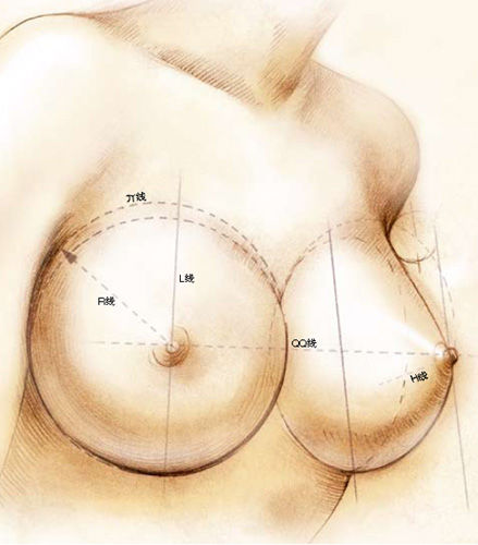 缩小乳头乳晕——塑造好乳房