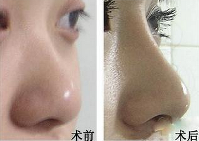 自体软骨隆鼻手术价格