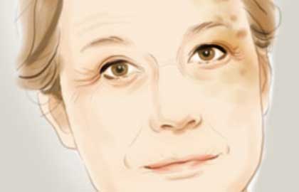 激光祛痘需要多少钱