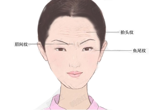 上海非手术注射方法可以去除眉间纹吗