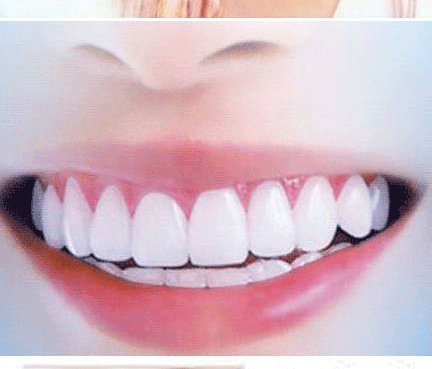 上海什么方法可以矫正牙齿缝隙大