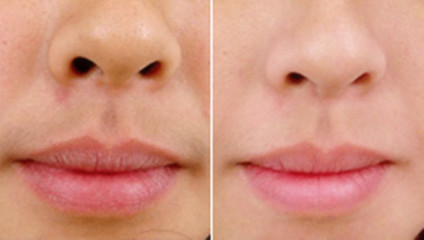 有哪些方法可以脱唇毛？